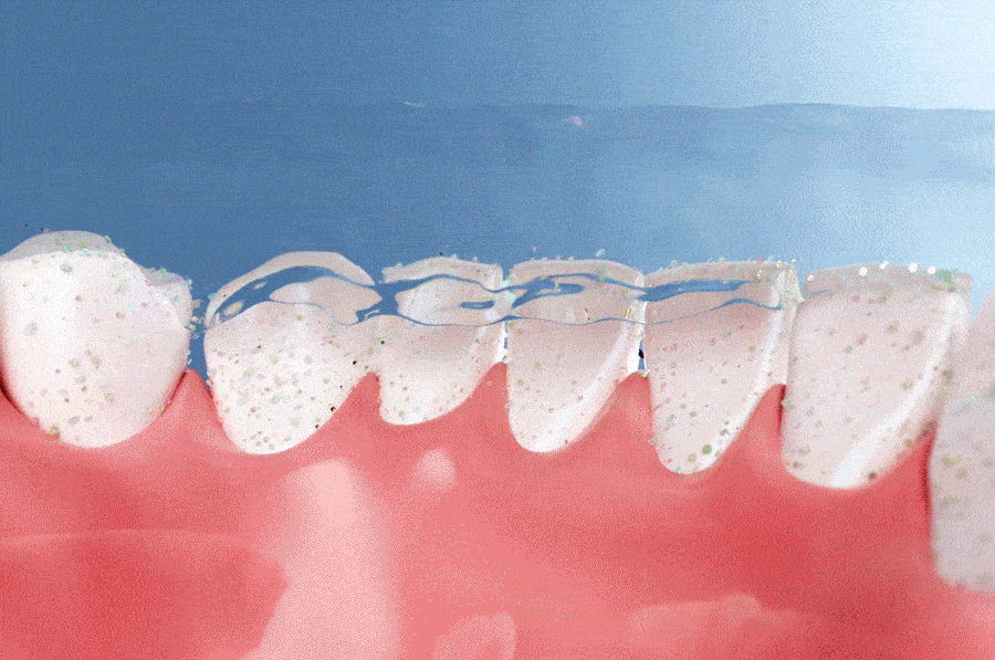 Illustration of E-PUROS active oral-care water rinsing around teeth, braces and the gumline.